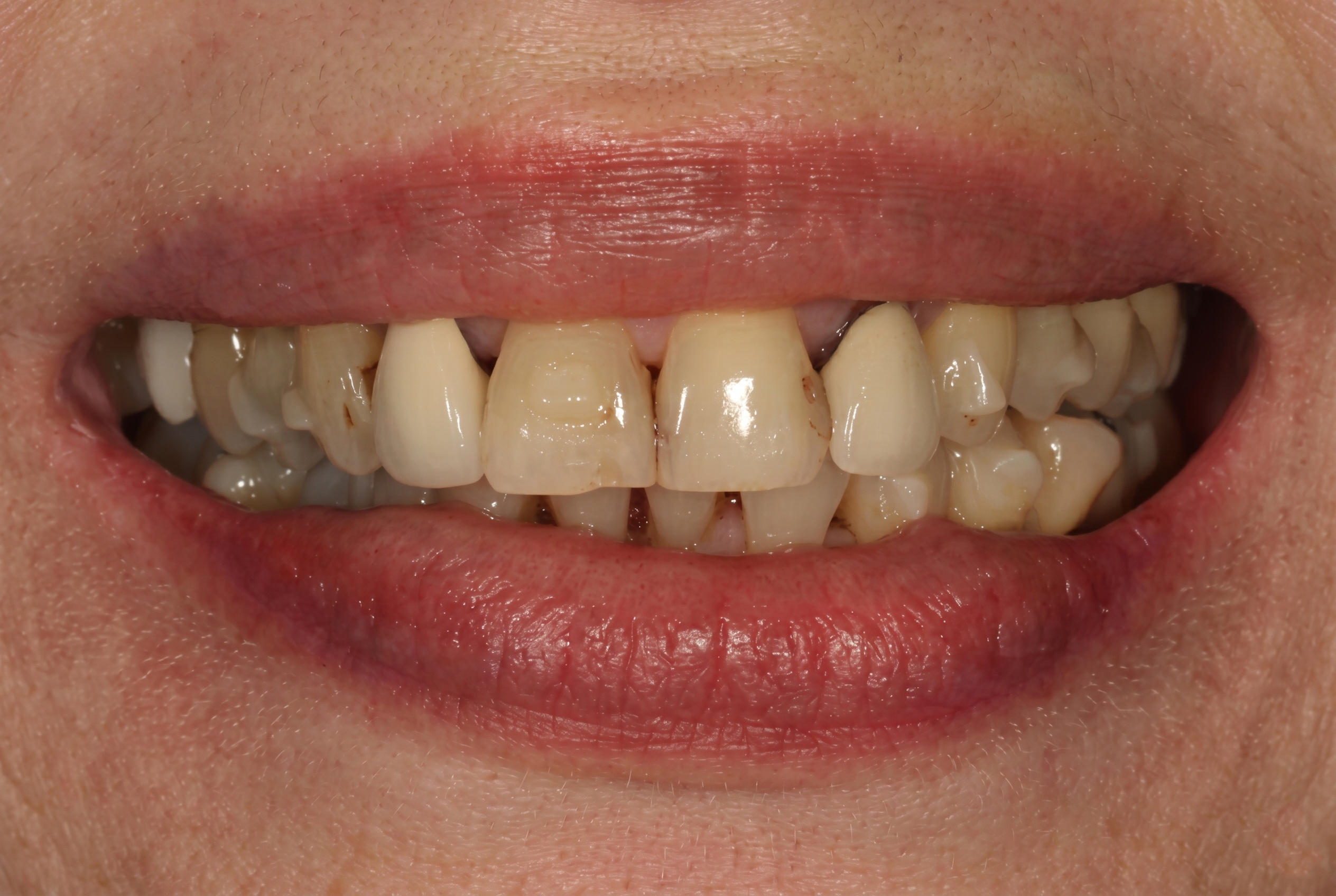 Full Mouth Rehabilitation - Before
